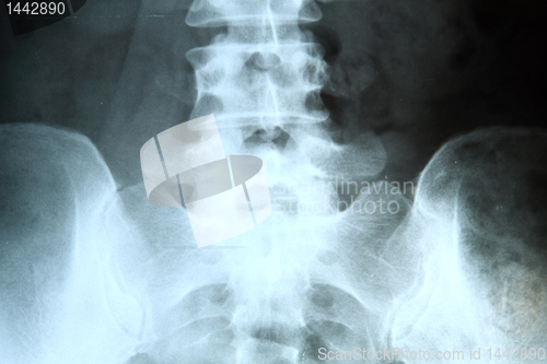 Image of X-ray of the pelvis and spinal column. 