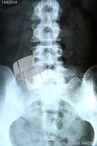 Image of X-ray of the pelvis and spinal column. 