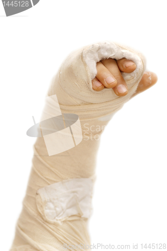 Image of Broken arm