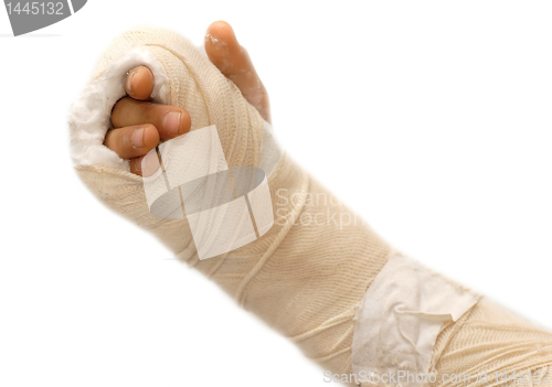 Image of Broken arm