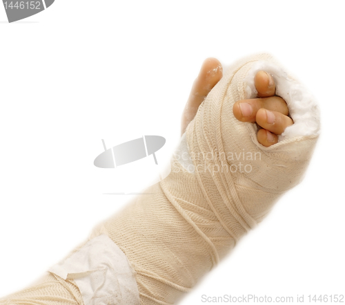 Image of Broken arm