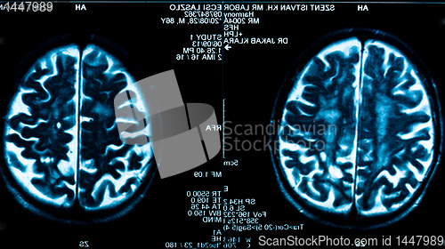 Image of Closeup of a computer axial tomography scan (CAT scan)