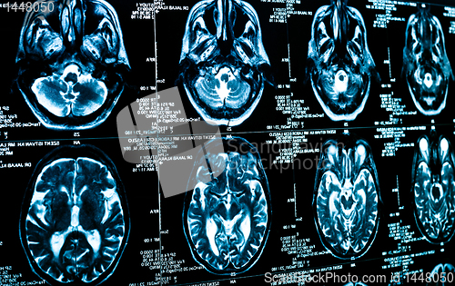 Image of Closeup of a computer axial tomography scan (CAT scan)