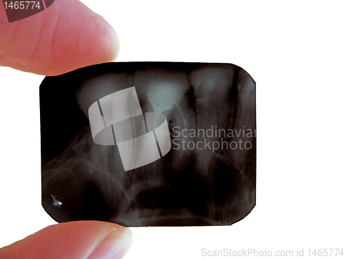 Image of roentgenogram of teeth