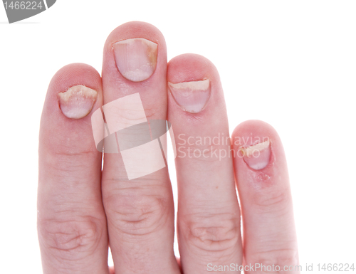 Image of Psoriasis on Fingernails Isolated White Background