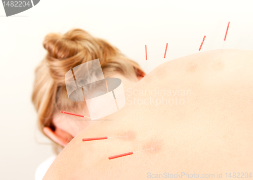 Image of Acupuncture Patient Treatment in Back