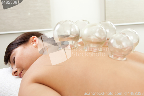 Image of Acupuncture Cupping Treatment