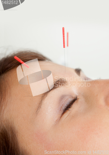 Image of Facial Acupuncture