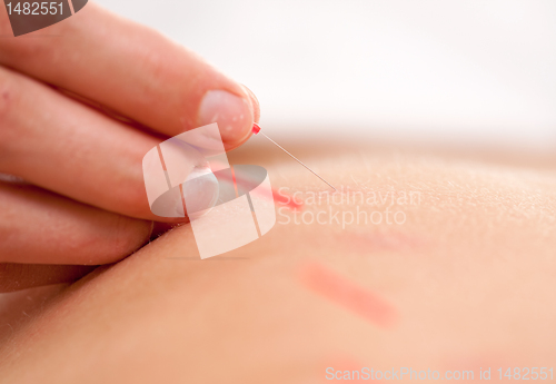 Image of Acupuncture Stimulation Macro