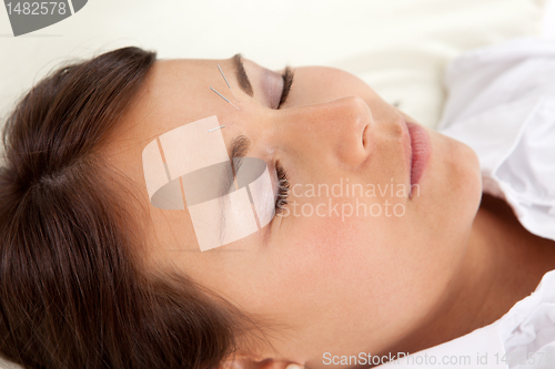 Image of Facial Acupuncture Treatment