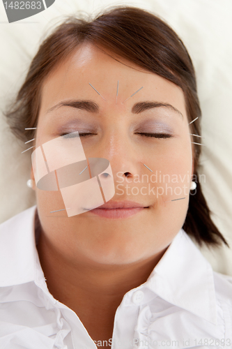 Image of Facial Beauty Acupuncture Treatment