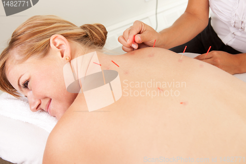 Image of Back Shu Acupuncture