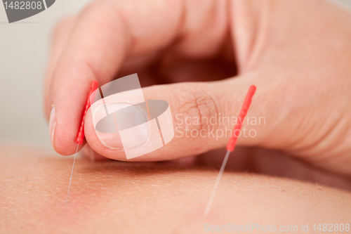 Image of Acupuncture Macro