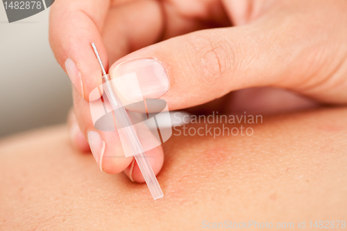 Image of Acupuncture Needle with Insertion Tube