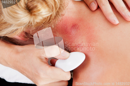 Image of Redness on Neck after Gua Sha Acupuncture