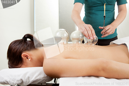 Image of Cuppping Acupuncture Treatment on Female Back