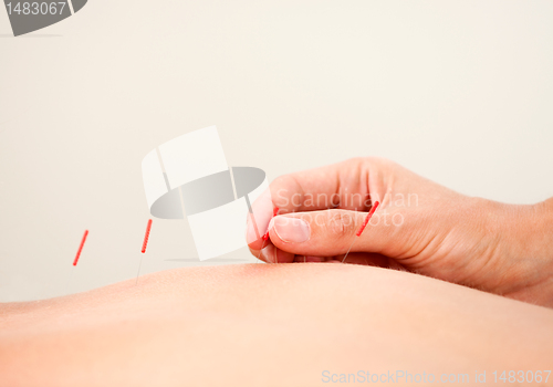 Image of Acupuncture