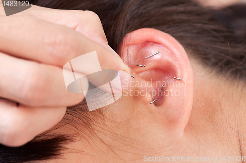 Image of Ear Acupuncture Detail