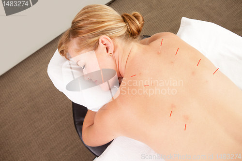 Image of Female Patient with Acupuncture Needles in Back