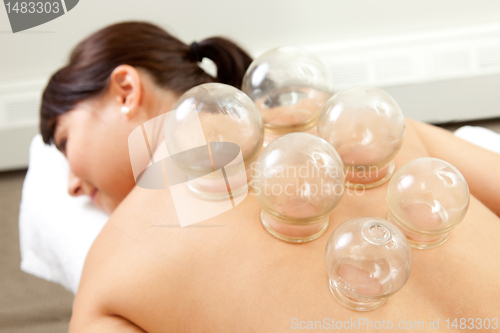 Image of Detail of Woman with Acupuncture Cupping Treatment