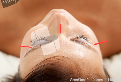 Image of Anti-Aging Acupuncture Treatment