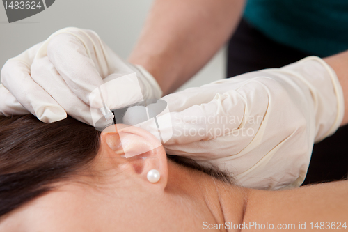 Image of Auricular Acupuncture Treatment