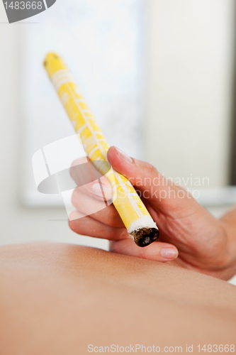 Image of Moxibustion Acupuncture Technique