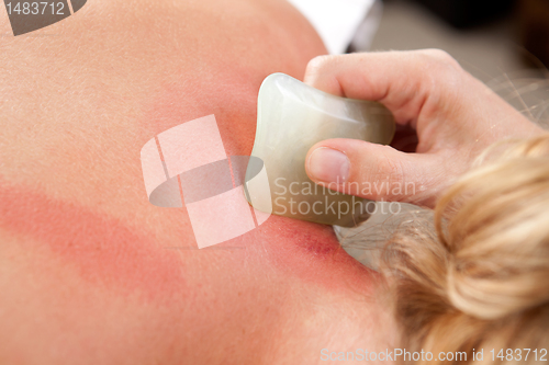 Image of Redness During Gua Sha