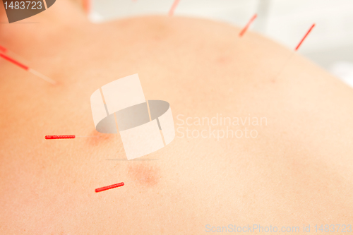 Image of Back Acupuncture