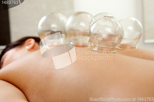 Image of Fire Cupping