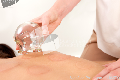 Image of Acupuncturist Removing Fire Cupping Bulb