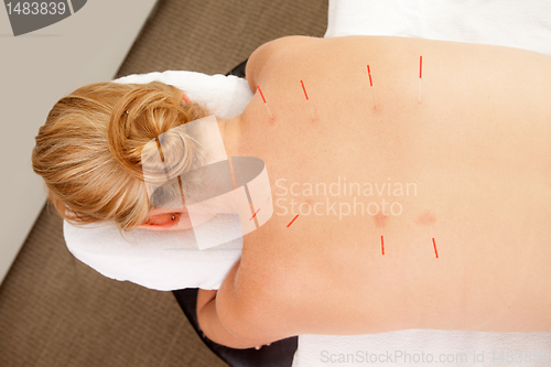 Image of Back Shu Acupuncture Points