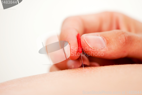 Image of Acupuncture Needle Being Stimulated