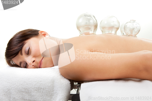 Image of Female Receiving Acupuncture Cupping Treatment