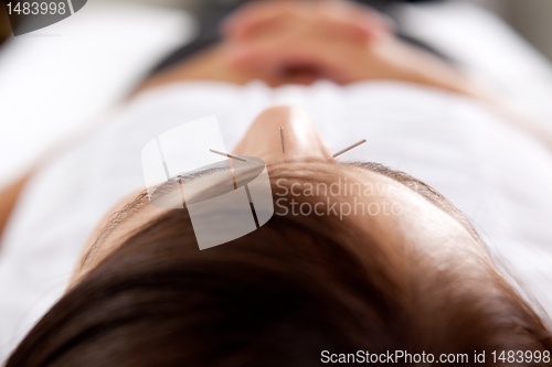 Image of Acupuncture Facial Treatment Detail