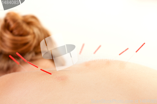 Image of Acupuncture on Back Shu Points