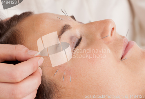 Image of Facial Acupuncture Treatment Detail