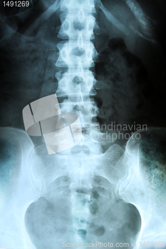 Image of X-ray of the pelvis and spinal column. 