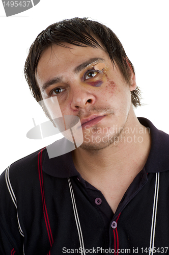 Image of man with black eye
