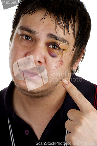 Image of man pointing at his black eye