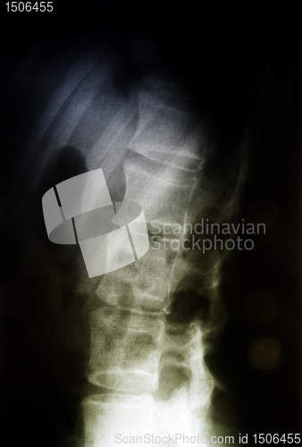 Image of X-ray