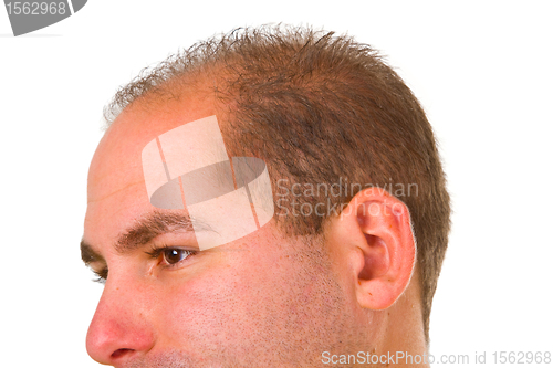 Image of Young man with hair problem
