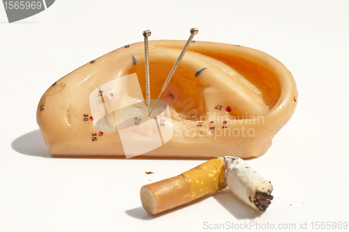 Image of acupuncture to stop smoking