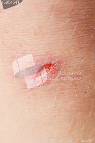 Image of scar