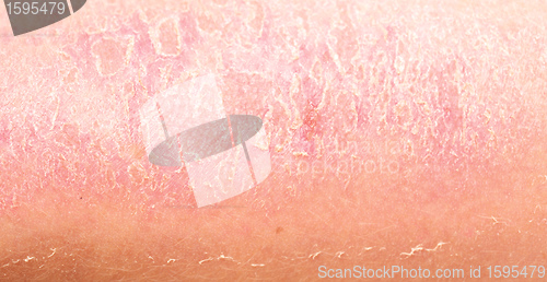 Image of sunburn