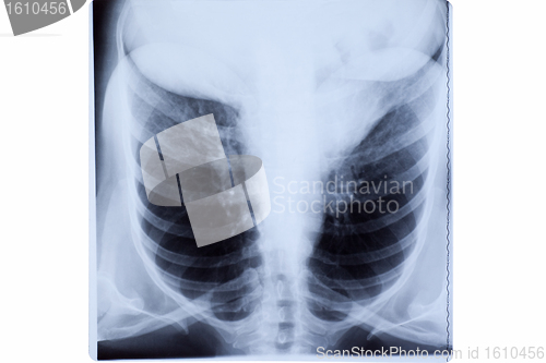 Image of Woman Chest X-ray