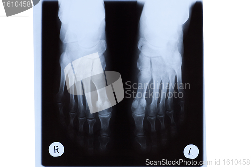 Image of X-ray of Mature Woman Feet