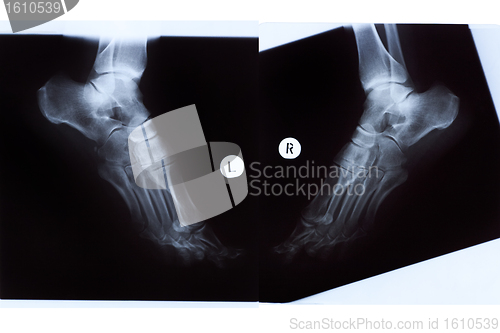 Image of X-ray of Mature Woman Feet
