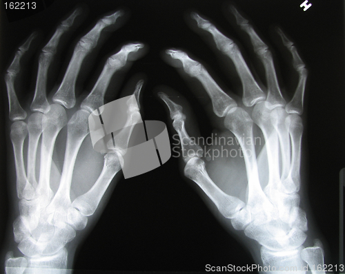 Image of X-Ray hands