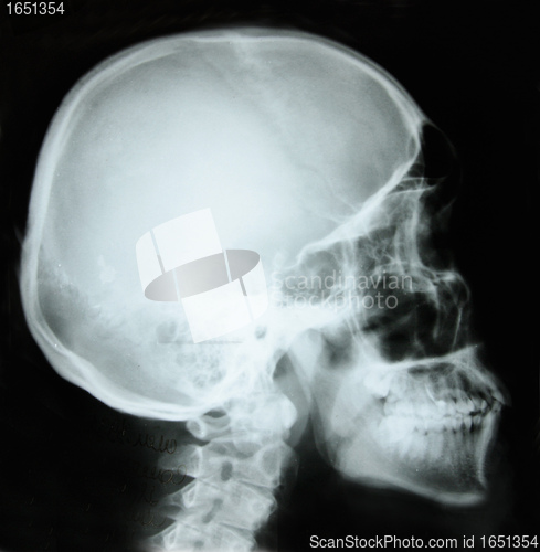 Image of photo of side x-ray picture of human skull in natural colors